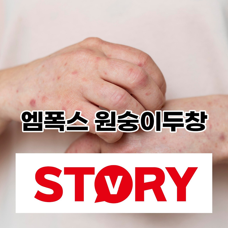 엠폭스란? 엠폭스 원숭이두창 원인 증상 감염경로 감염원인 알아보기