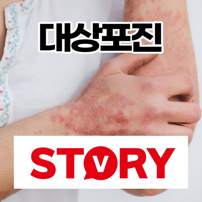 대상포진 정의 대상포진 증상 및 치료방법