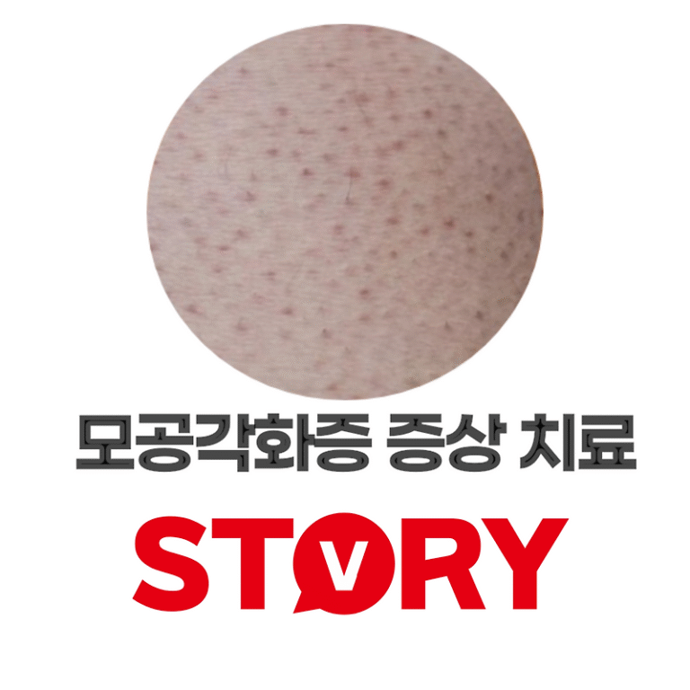모공각화증이란? 모공각화증 원인, 증상, 그리고 효과적인 치료 방법 (※모공각화증은 완치 가능한가?)