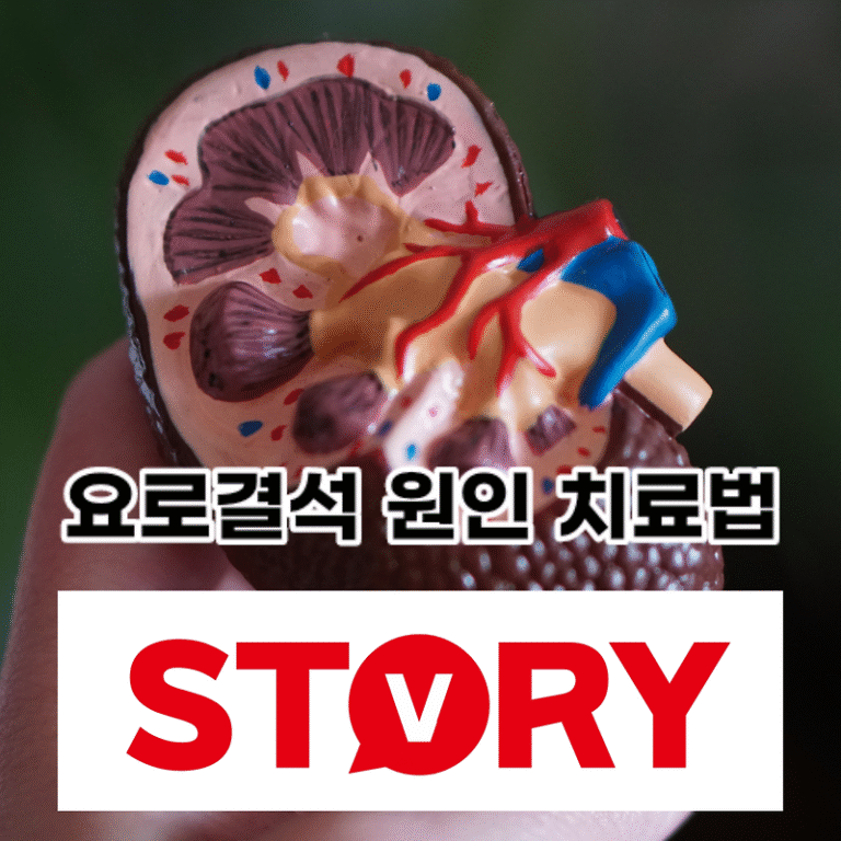 신장요로결석 원인 증상 및 치료방법 요로결석 피해야 하는 음식 (ft : 요로결석 체외충격파 치료 비용)