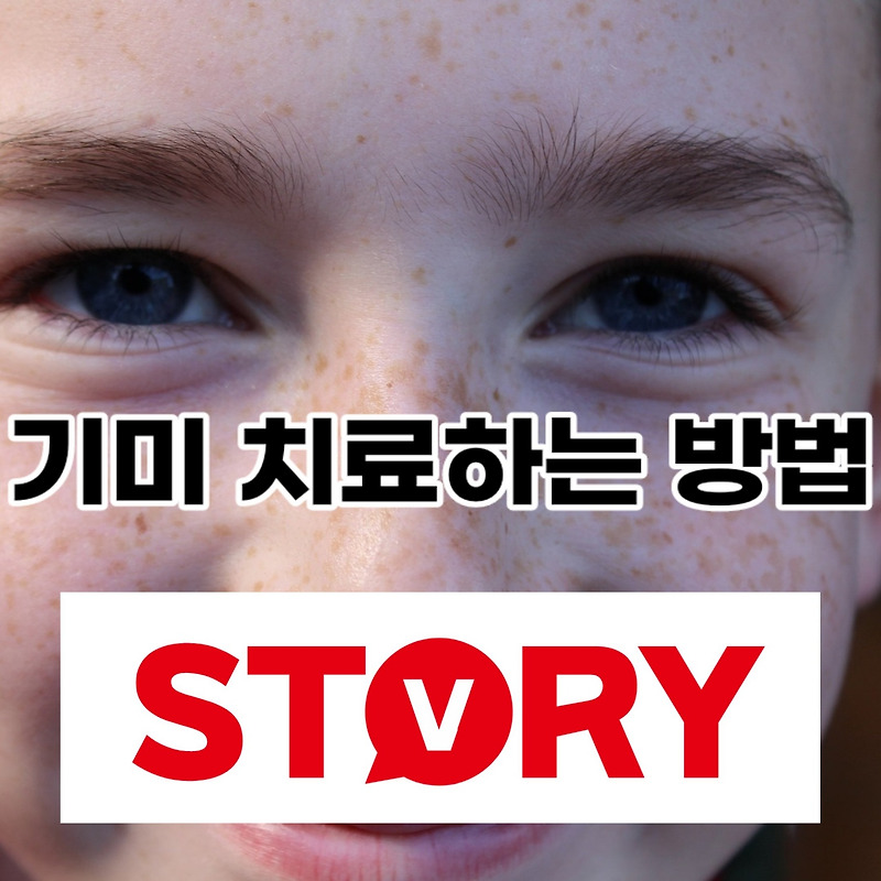 기미 원인 치료하는 방법 6가지 기미 없애는 방법 (ft : 기미크림, 기미 레이저치료)